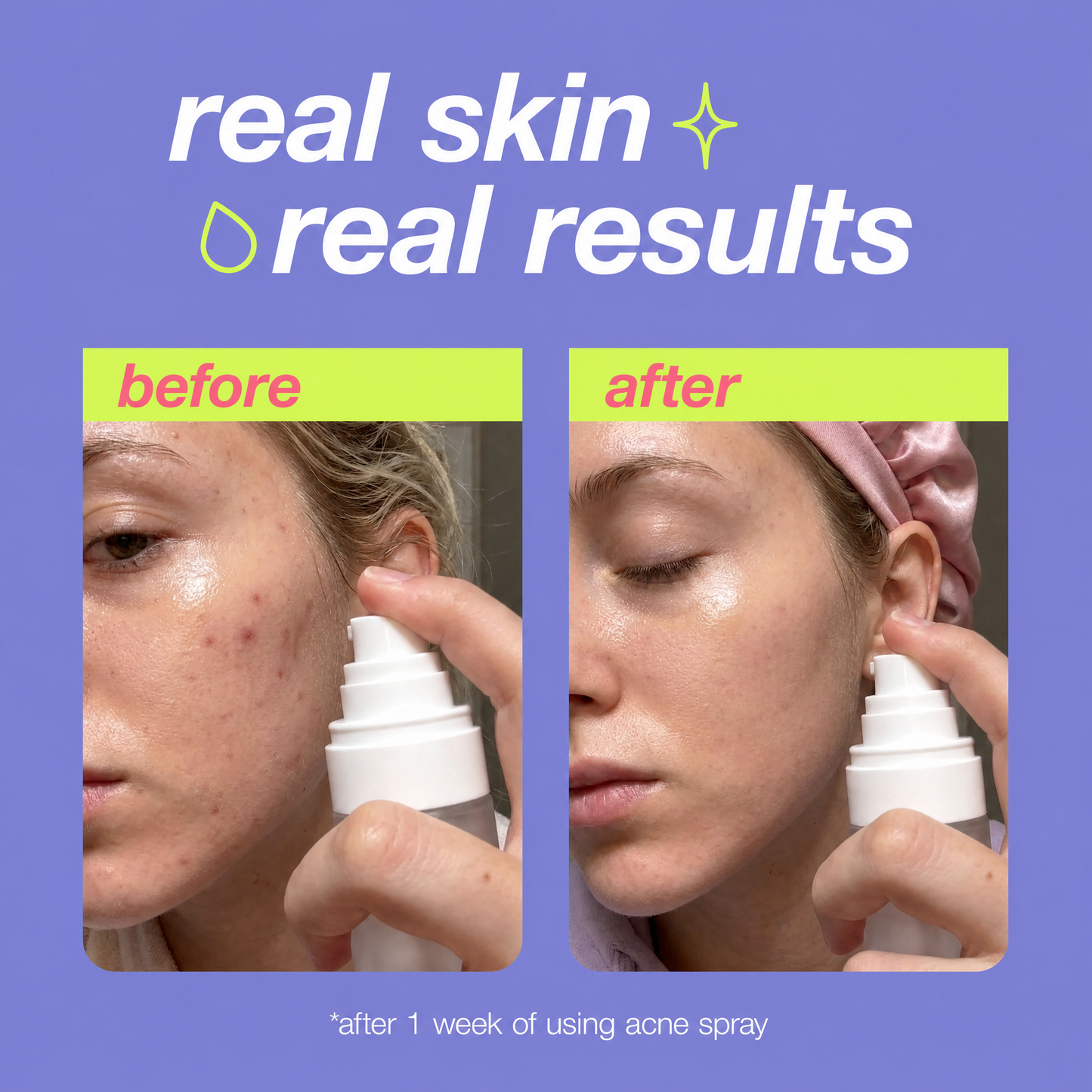 Seoul Acne Spray™