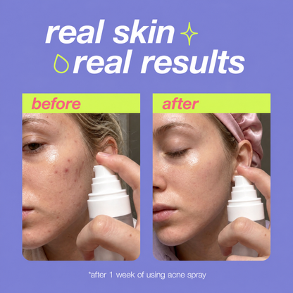 Seoul Acne Spray™